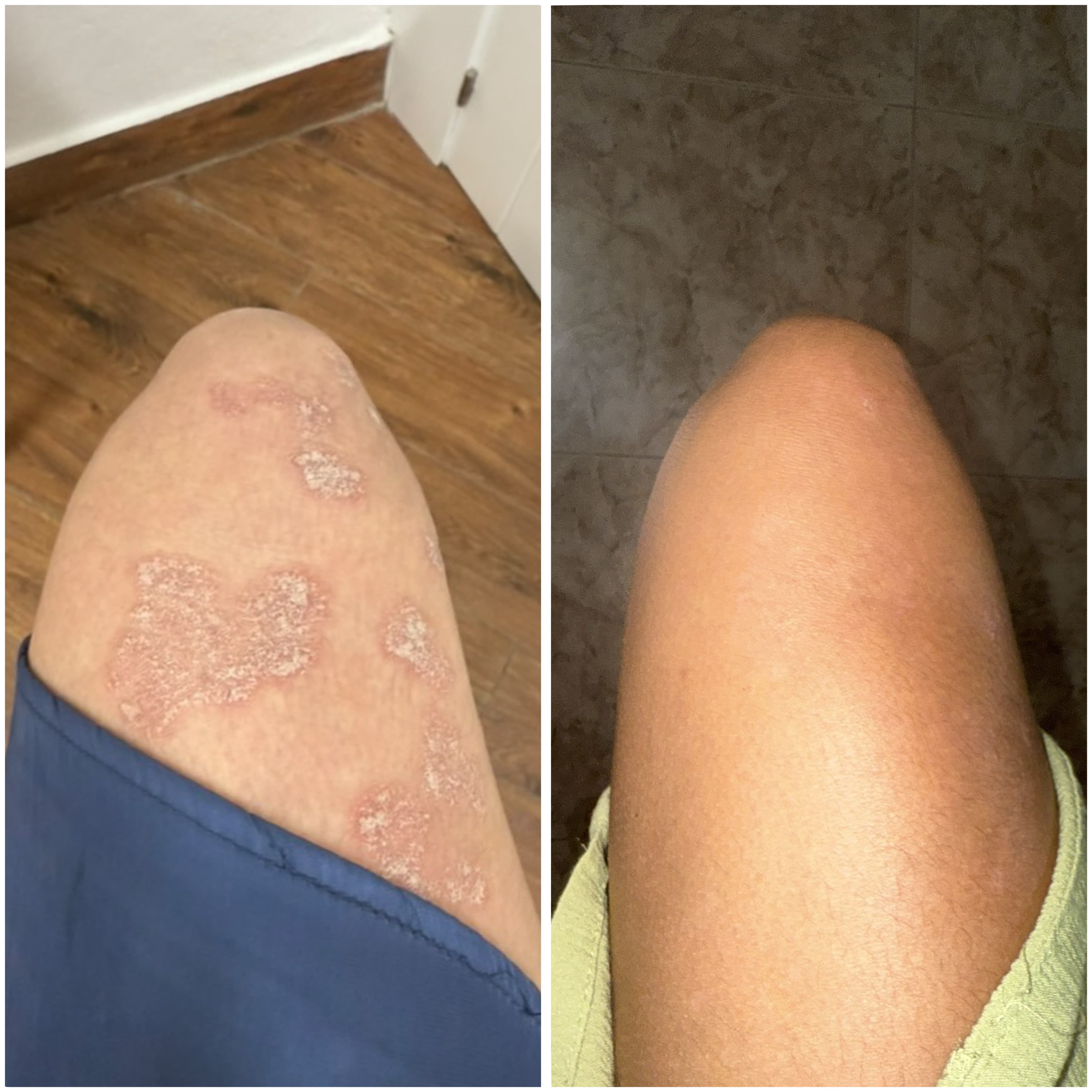 Crema reparadora de CBD para piel seca, descamada y con tendencia a la psoriasis.