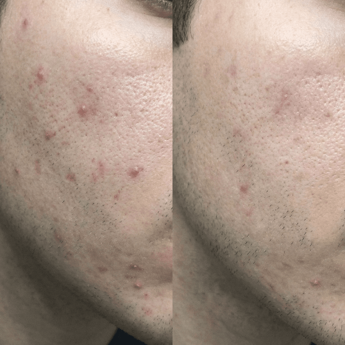 Crema CBD purificante para pieles propensas al acné
