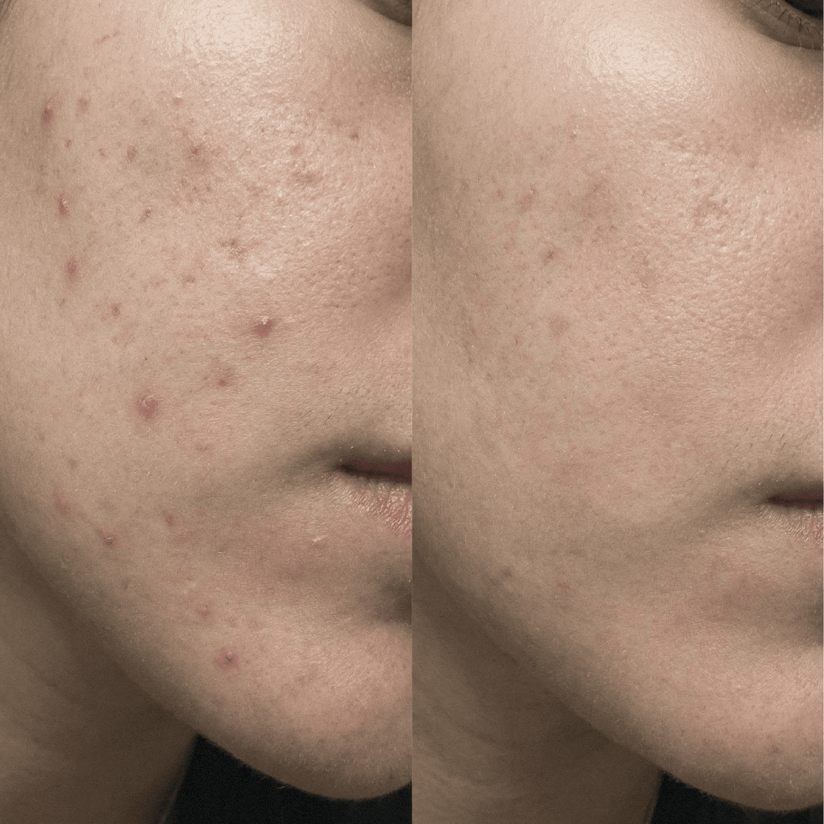Crema CBD purificante para pieles propensas al acné