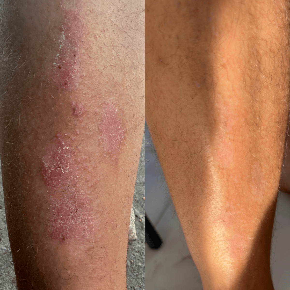Crema reparadora de CBD para piel seca, descamada y con tendencia a la psoriasis.